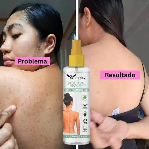 BACK ACNE® Elimina el acné de tu espalda de forma rápida sin resecar ni irritar la piel